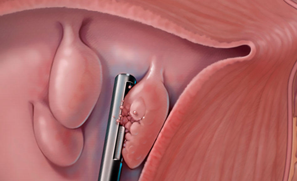 Операции по поводу опущений и выпадений влагалища и матки (пролапс тазовых органов)