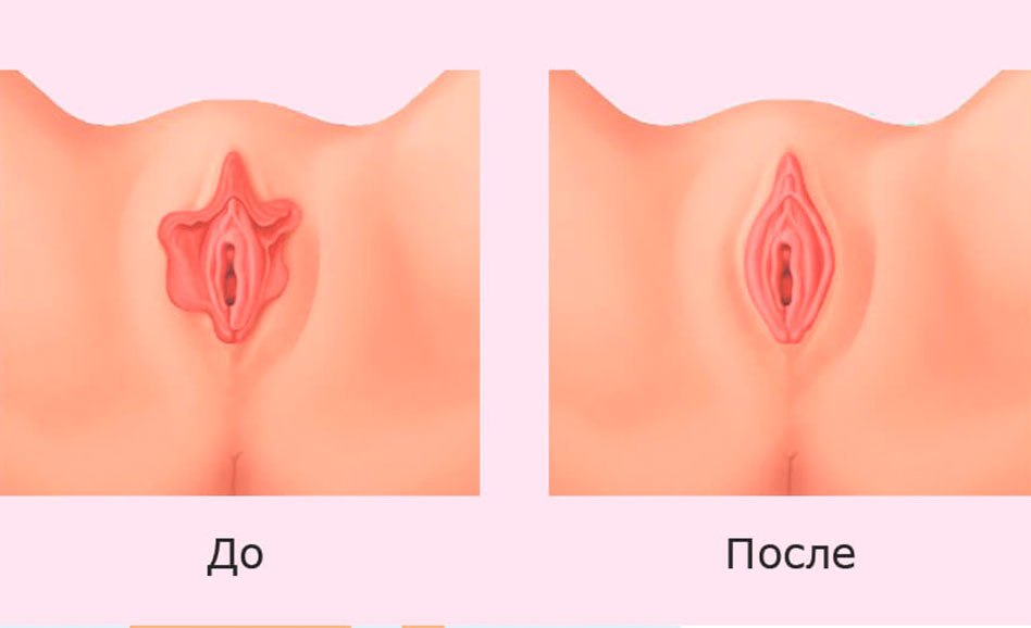 Синехии (сращение) малых половых губ у девочек